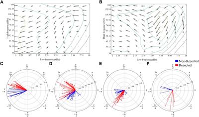 Classifying epileptic phase-amplitude coupling in SEEG using complex-valued convolutional neural network